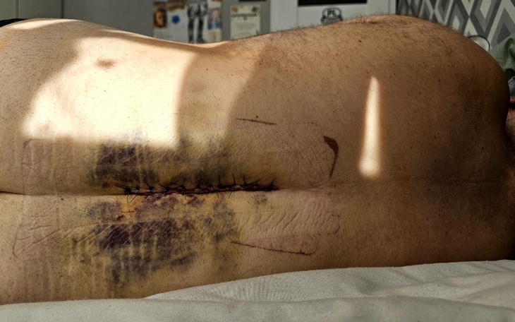 Ciało mężczyzny z raną pooperacyjną na plecach.
