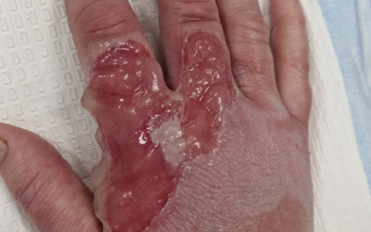 Zbiórka Dla poparzonej koleżanki - zdjęcie główne