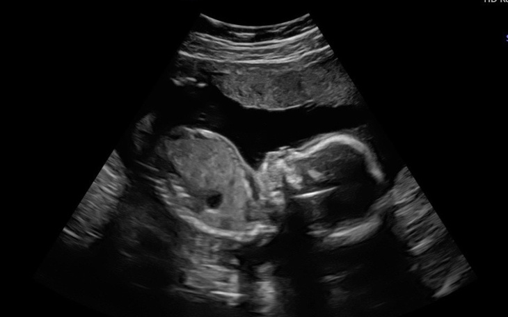 Ultrasonografia pokazująca rozwijający się płód.