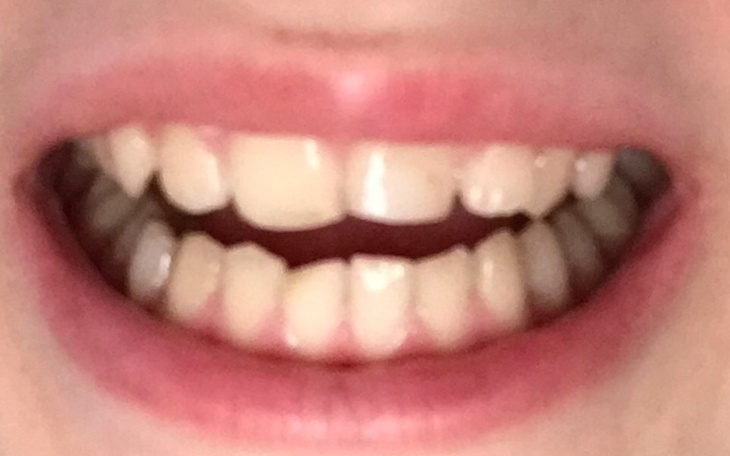 Zbiórka Na ładne, proste zęby - zdjęcie główne