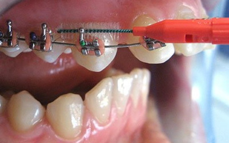 Zbiórka Zbiórka na aparat ortodontyczny - zdjęcie główne