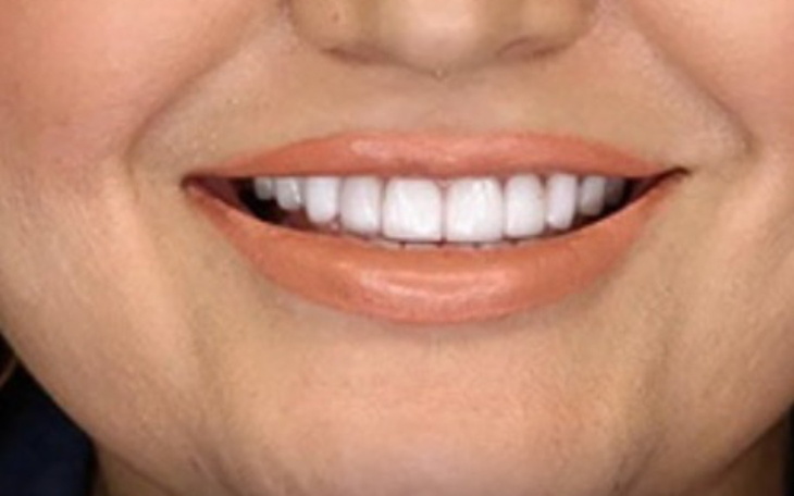 Zbliżenie na uśmiech z białymi zębami.