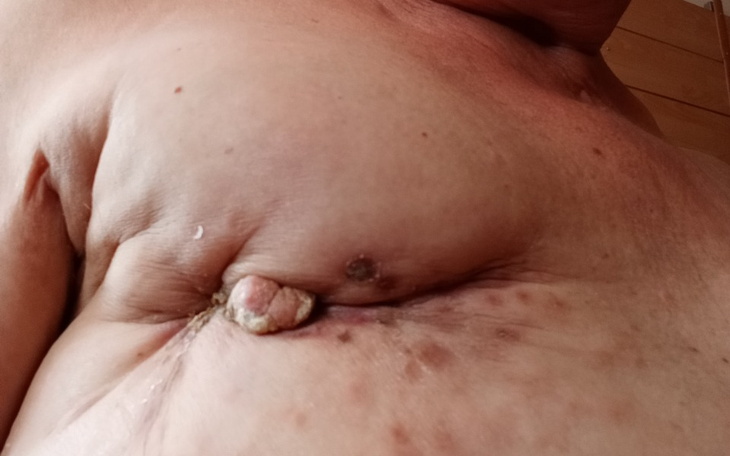 Zbiórka Zakup rękawa do drenażu limfatyc - zdjęcie główne