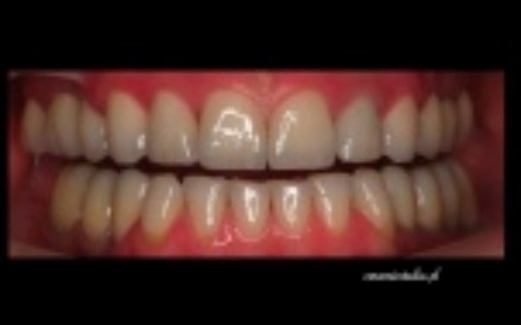 Zbiórka Nowe Zęby-  Implanty i Koronki ! - zdjęcie główne