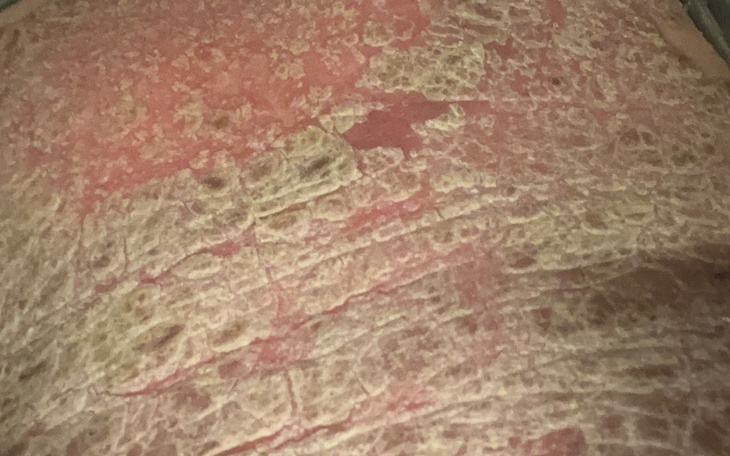 Zbliżenie na skórę z widocznymi zmianami.