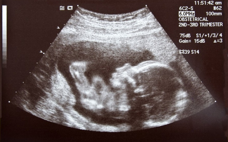 Zbiórka Noworodwk - zdjęcie główne