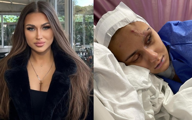 Porównanie zdjęcia przed i po wypadku, ukazujące poważne obrażenia.