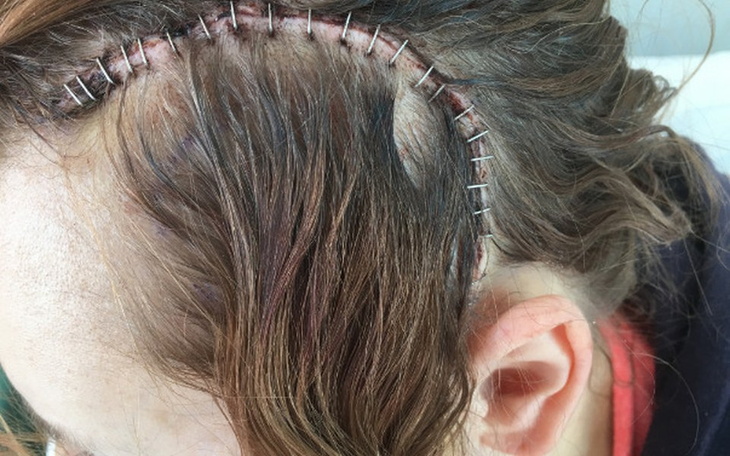 Zbiórka Leczenie glejaka - zdjęcie główne