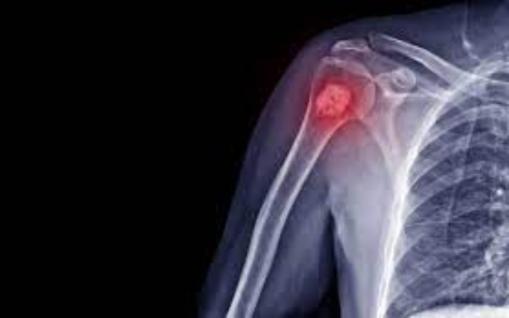 Zbiórka Walka Dziadka z rakiem kości - zdjęcie główne