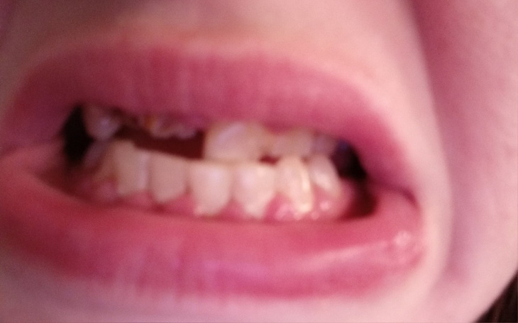 Uśmiech z widocznymi zębami, pokazujący urok dzieciństwa.