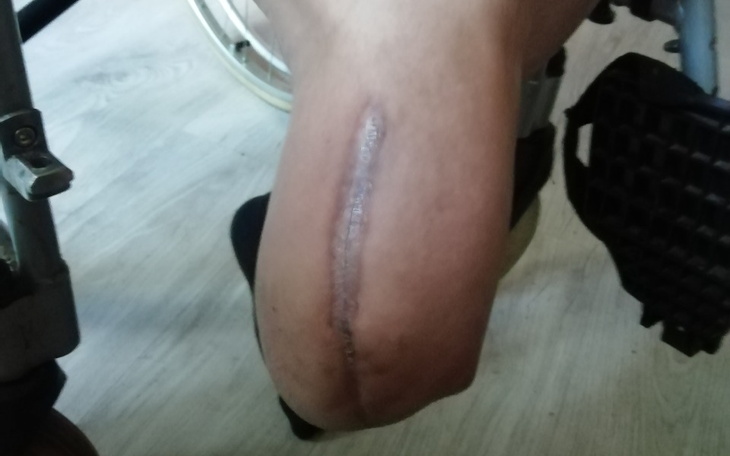 Zbiórka Na protezę prawej nogi - zdjęcie główne