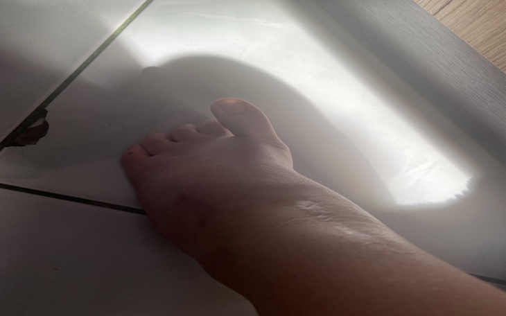 Zbiórka Wada nogi Końsko szpotawa - zdjęcie główne