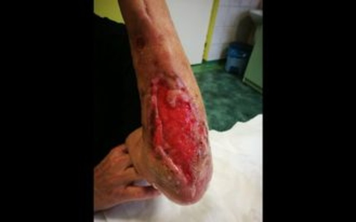 Zbiórka Operacja - Rana cukrzycowa - zdjęcie główne