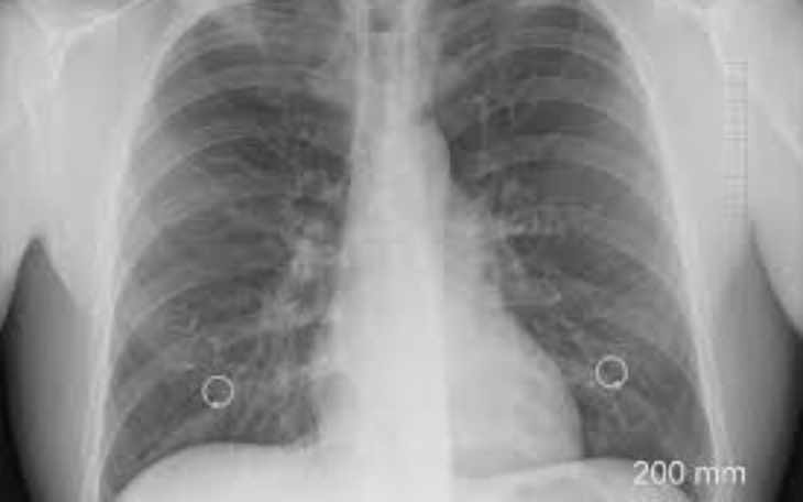 Zbiórka Pomoc w pokonaniu raka płuc - zdjęcie główne