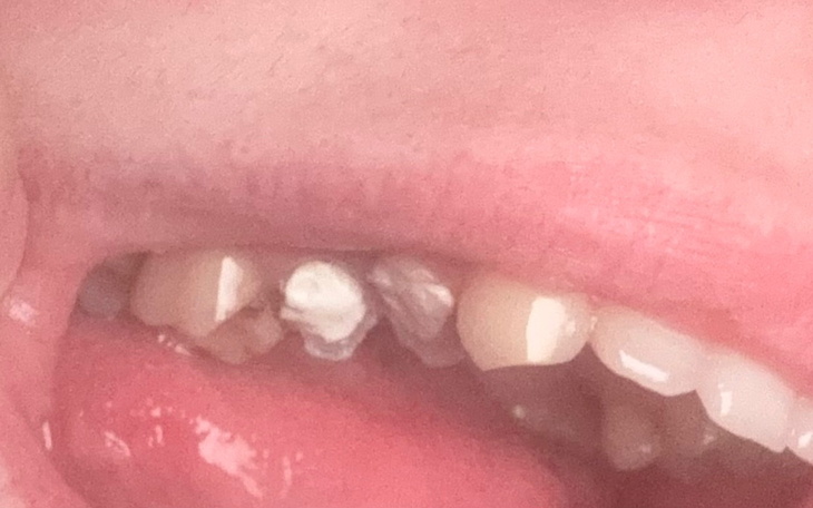 Uszkodzone zęby z widocznymi ubytkami w jamie ustnej.