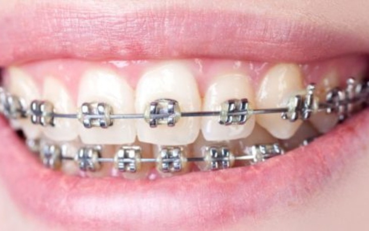 Zbiórka Brakuje mi na aparat na zęby - zdjęcie główne