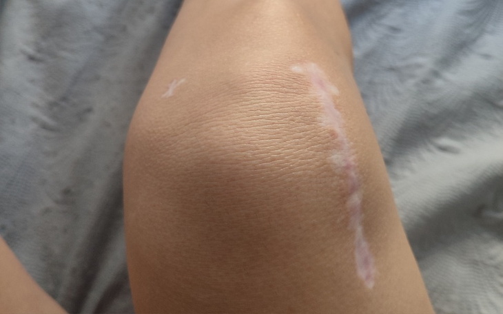 Zbiórka Pomoc na leczenie KOLANA - zdjęcie główne