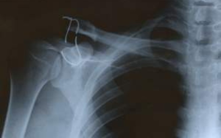 Zbiórka Na operacje mojego lewego barku - zdjęcie główne