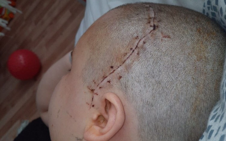 Dziecko po operacji, widoczna blizna na głowie.