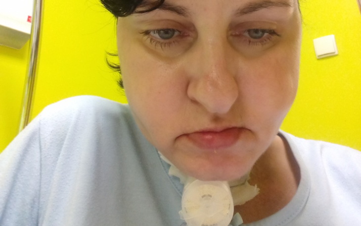 Kobieta w szpitalu, z widoczną rurką tracheotomiczną.