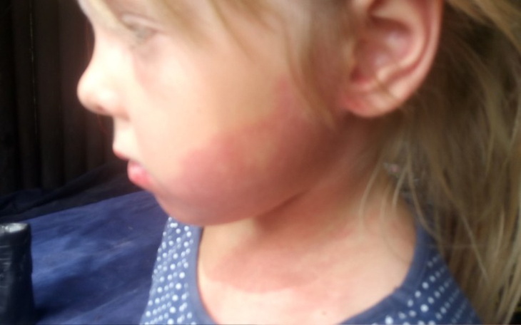 Zbiórka Pomóżmy Julci usunąć naczyniaka - zdjęcie główne