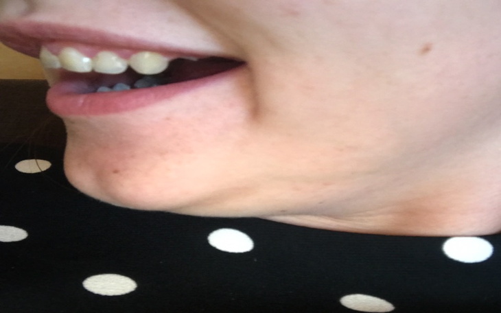 Zbiórka Zbiórka na zęby -choroba - zdjęcie główne