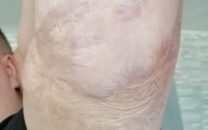 Zbiórka Tatuaż na bliznę - zdjęcie główne