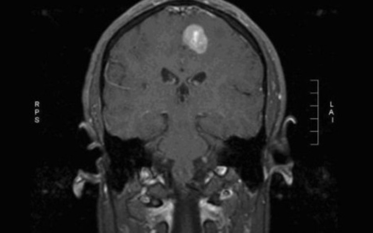 Obraz MRI pokazujący nieprawidłowości w mózgu.