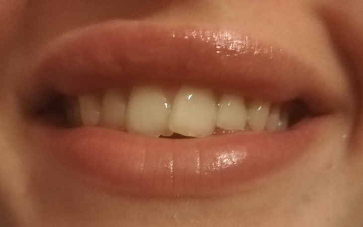 Zbiórka Zbieram na aparat ortodontyczn - zdjęcie główne