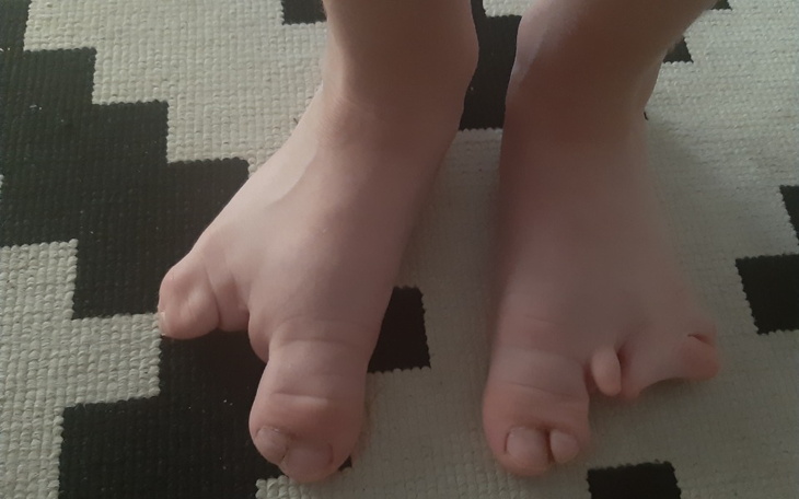 Zbiórka Operacja stóp rekonstrukcja - zdjęcie główne