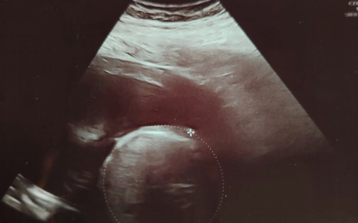 Ultrasonografia pokazująca rozwijający się płód.