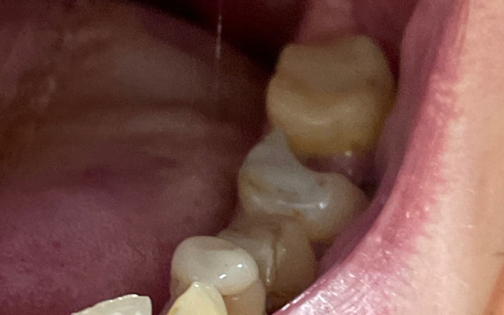 Zbiórka Leczenie zębów-aparat korony itp - zdjęcie główne