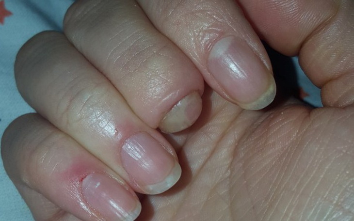 Zbiórka Proteza palca po amputacji - zdjęcie główne