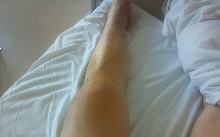 Widok na nogę z siniakiem, leżącą na łóżku szpitalnym.