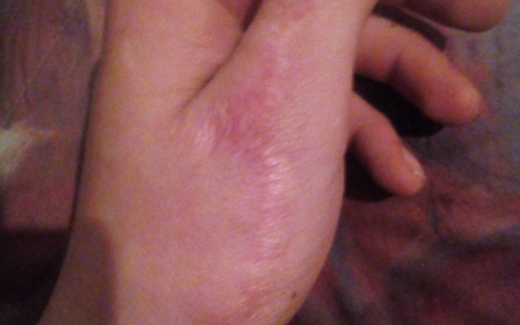 Zbiórka Operacja Kciuka Zerwane Wiązadła - zdjęcie główne