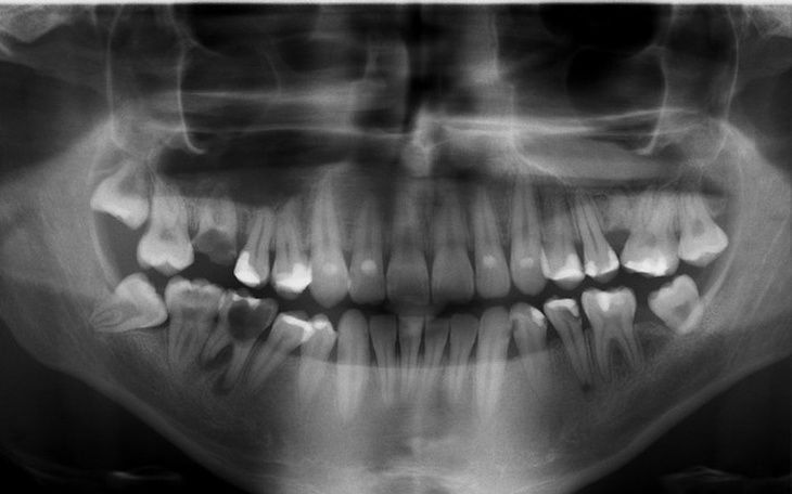 Zbiórka Narkoza dla zębów - zdjęcie główne
