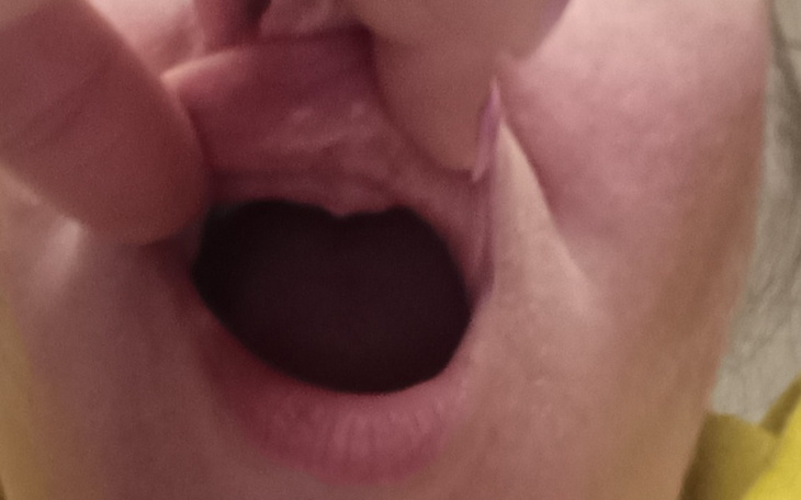 Osoba pokazująca wnętrze ust, z widocznymi zmianami.