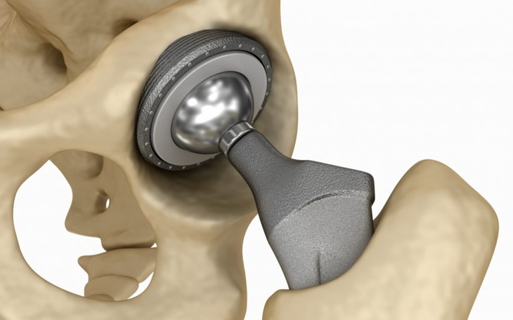 Ilustracja przedstawiająca implant stawu biodrowego.