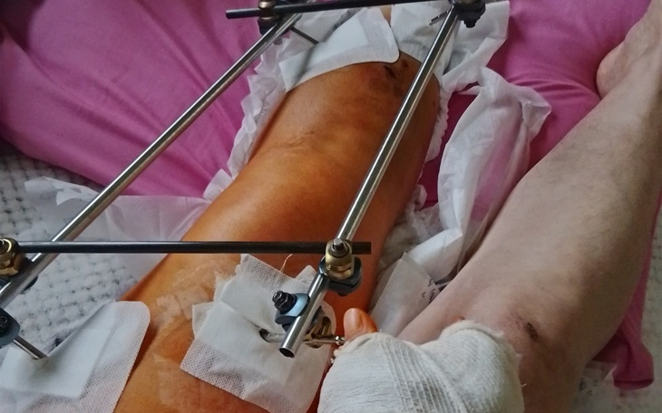 Zbiórka Przywrócenie sprawności nogi - zdjęcie główne