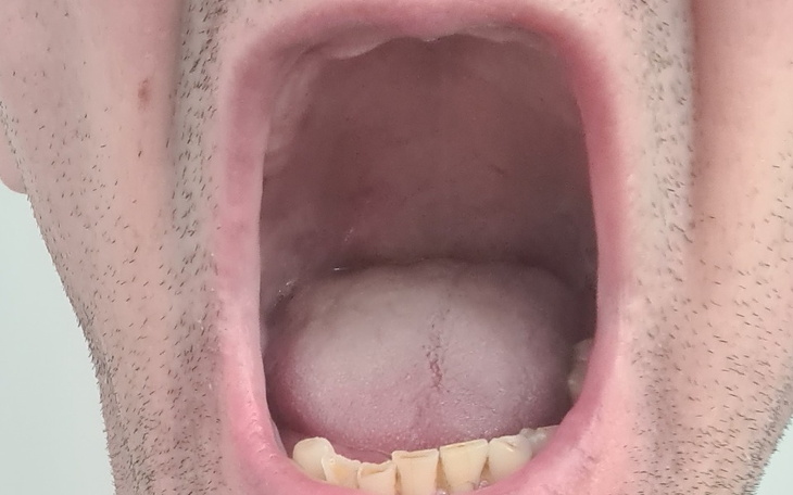 Zbiórka Implanty zębowe koronki - zdjęcie główne