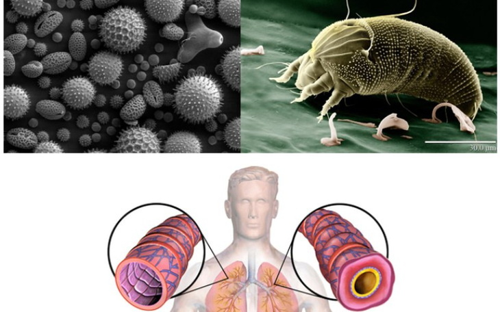 Zbiórka Pomóżmy astmatykom i alergikom - zdjęcie główne