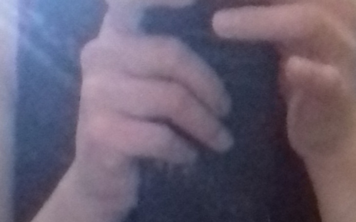 Zbiórka Rąk macicy z przerzutami - zdjęcie główne