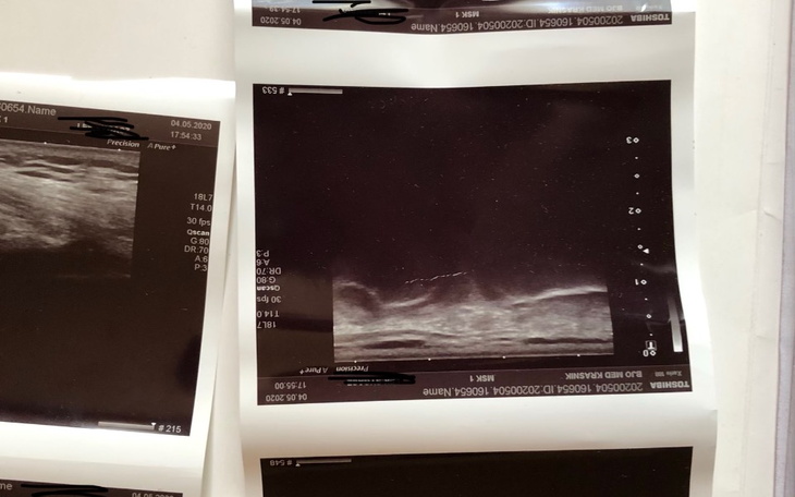 Zbiórka Zabieg rekonstrukcji więzadła - zdjęcie główne