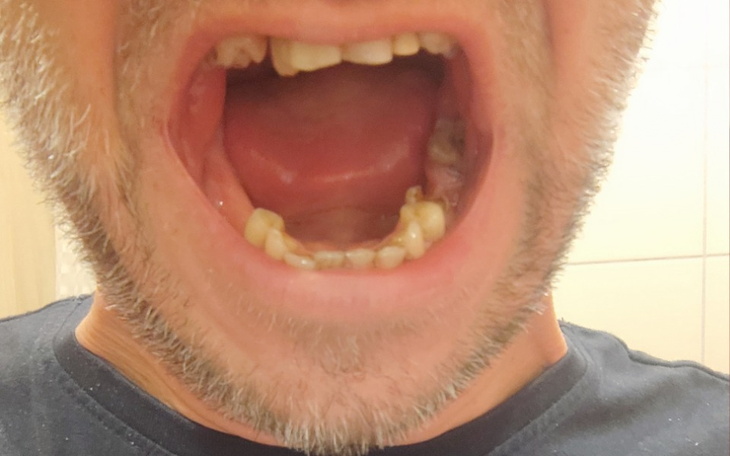 Zbiórka Na nowe zęby 40 latka - zdjęcie główne