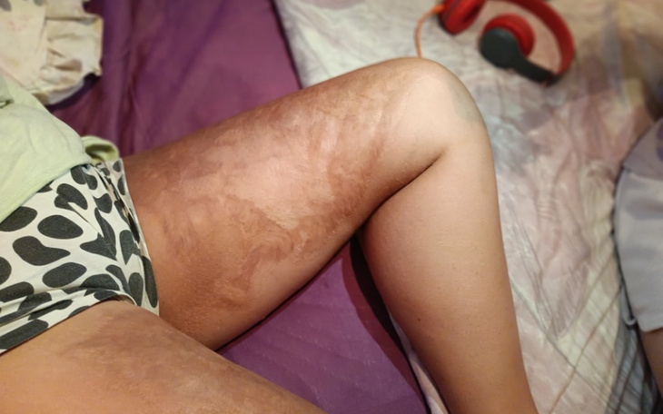 Zbiórka Poparzenie nóg leczenie w Niemcz - zdjęcie główne