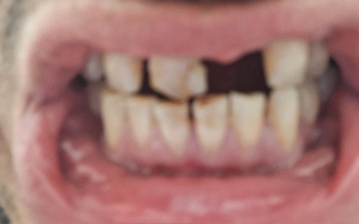 Zbliżenie na uśmiech z widocznymi uszkodzeniami zębów.