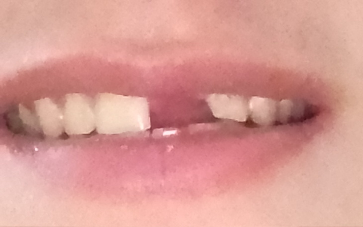 Zbiórka Zbieram na jedynkę zęba - zdjęcie główne