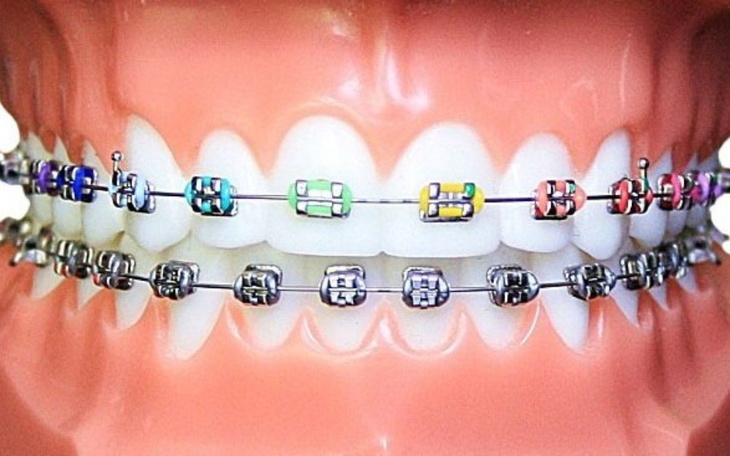 Zbiórka Aparat ortodontyczny ... - zdjęcie główne