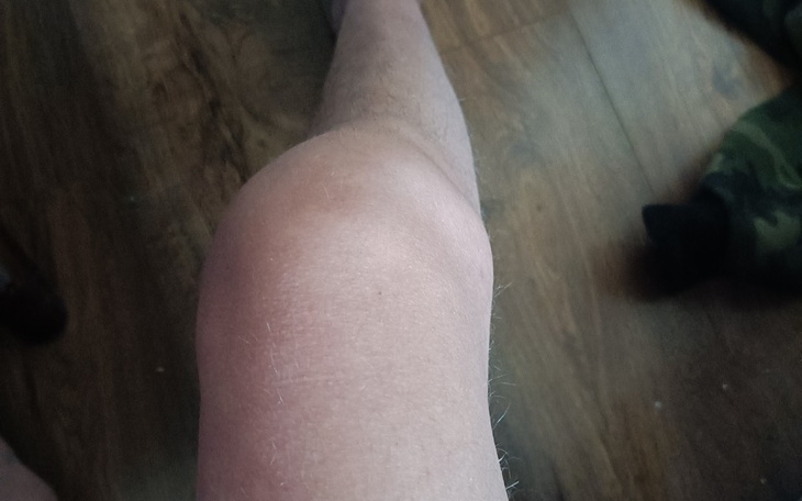 Zbiórka Pomoc na życie po operacji rehab - zdjęcie główne