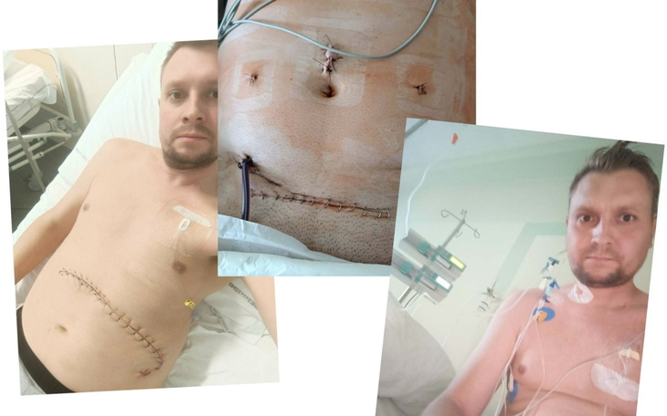 Mężczyzna po operacji, z widocznymi szwami na brzuchu.